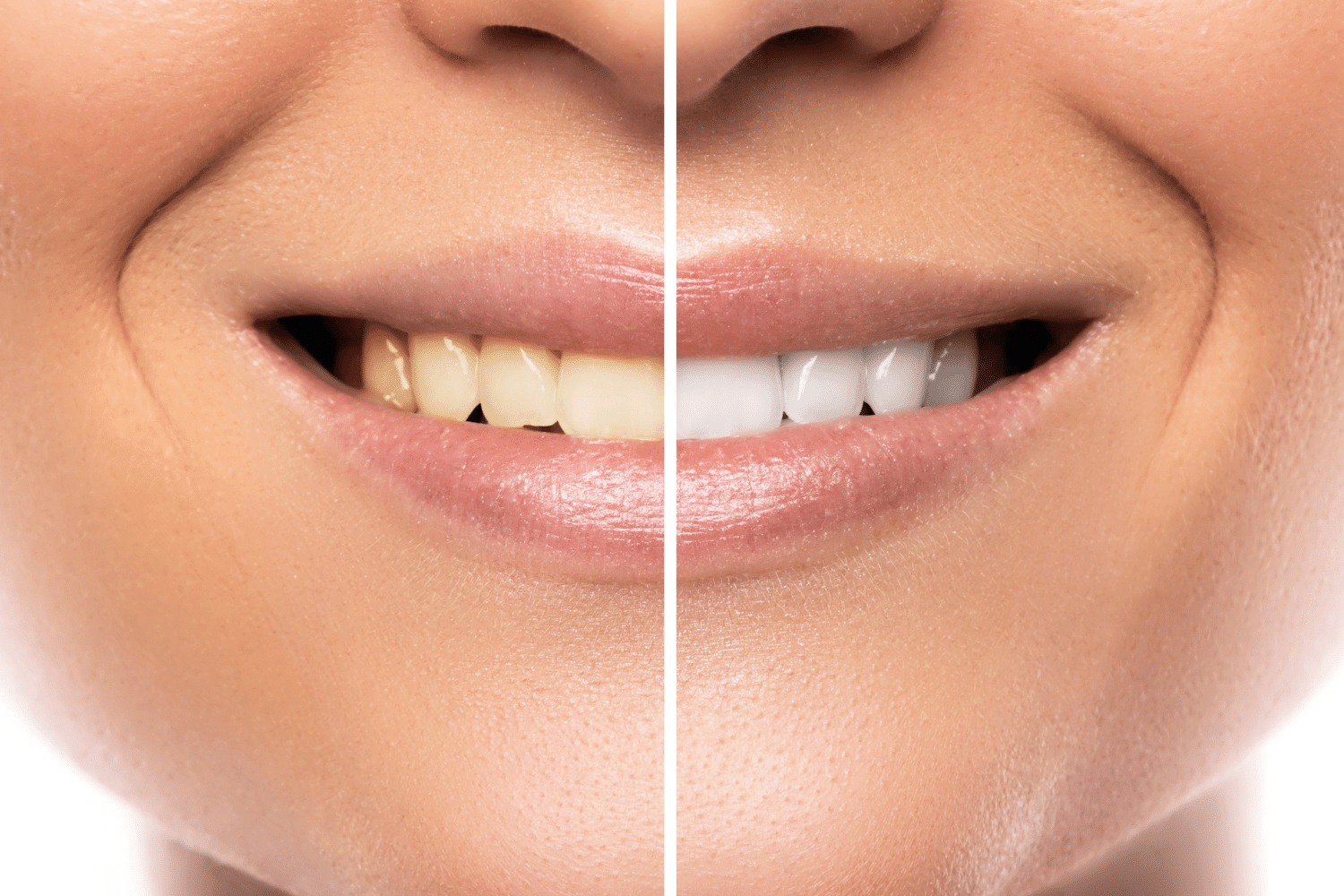 Cosmetic smile consultation in Bengaluru