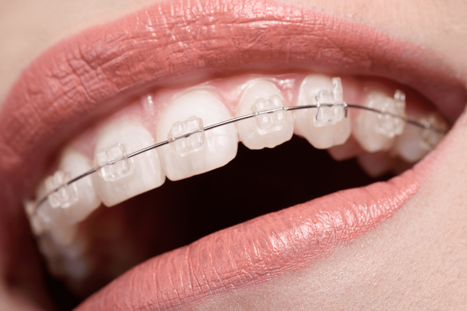 Veneers and smile design by Dental Clinic