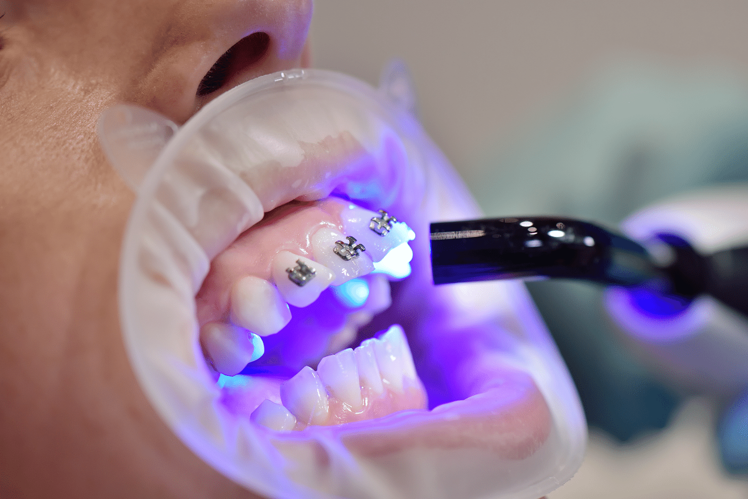 Teeth Whitening in Bengaluru by Dental Clinic