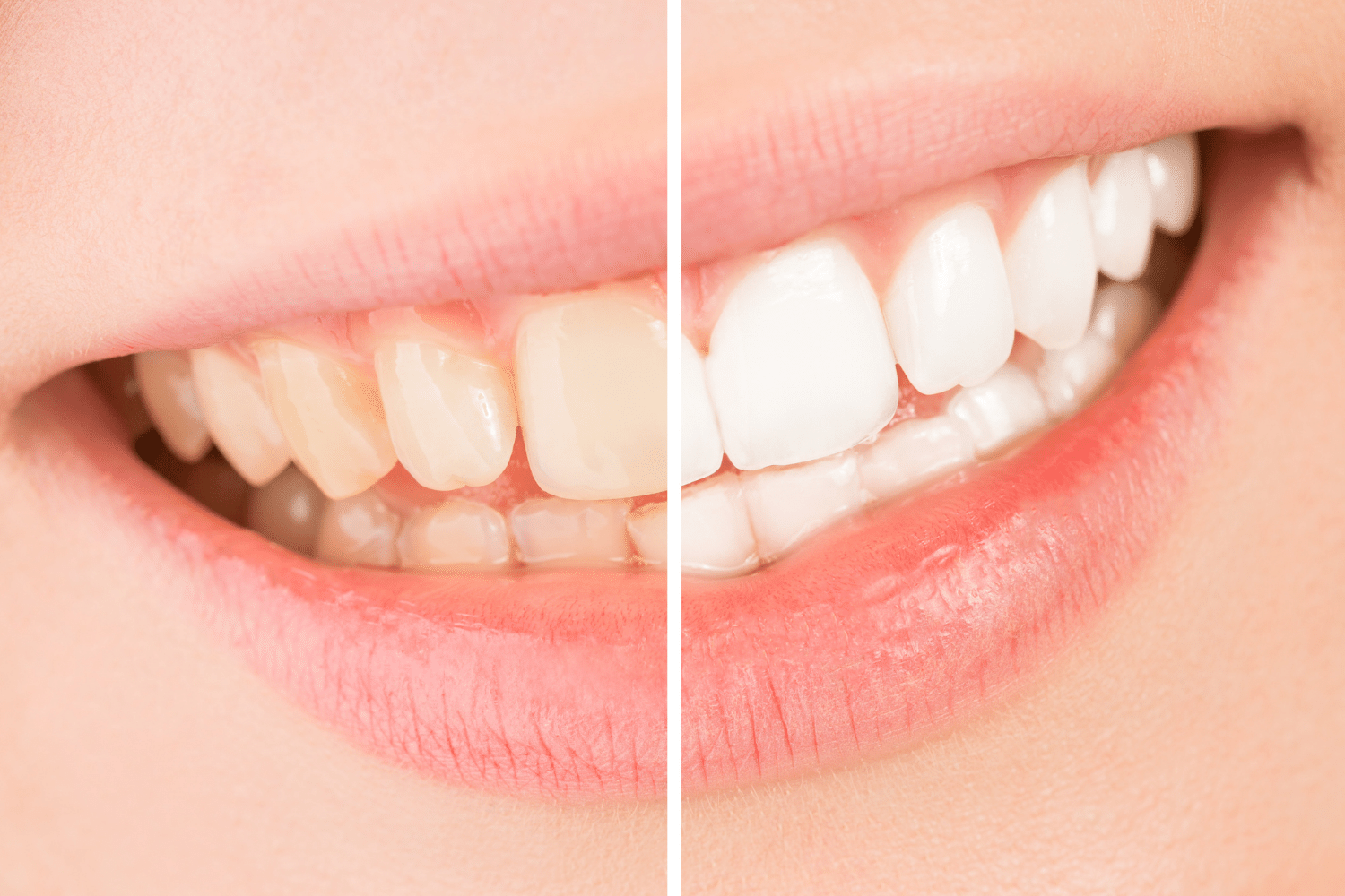 Teeth Whitening in Bengaluru by Dental Clinic