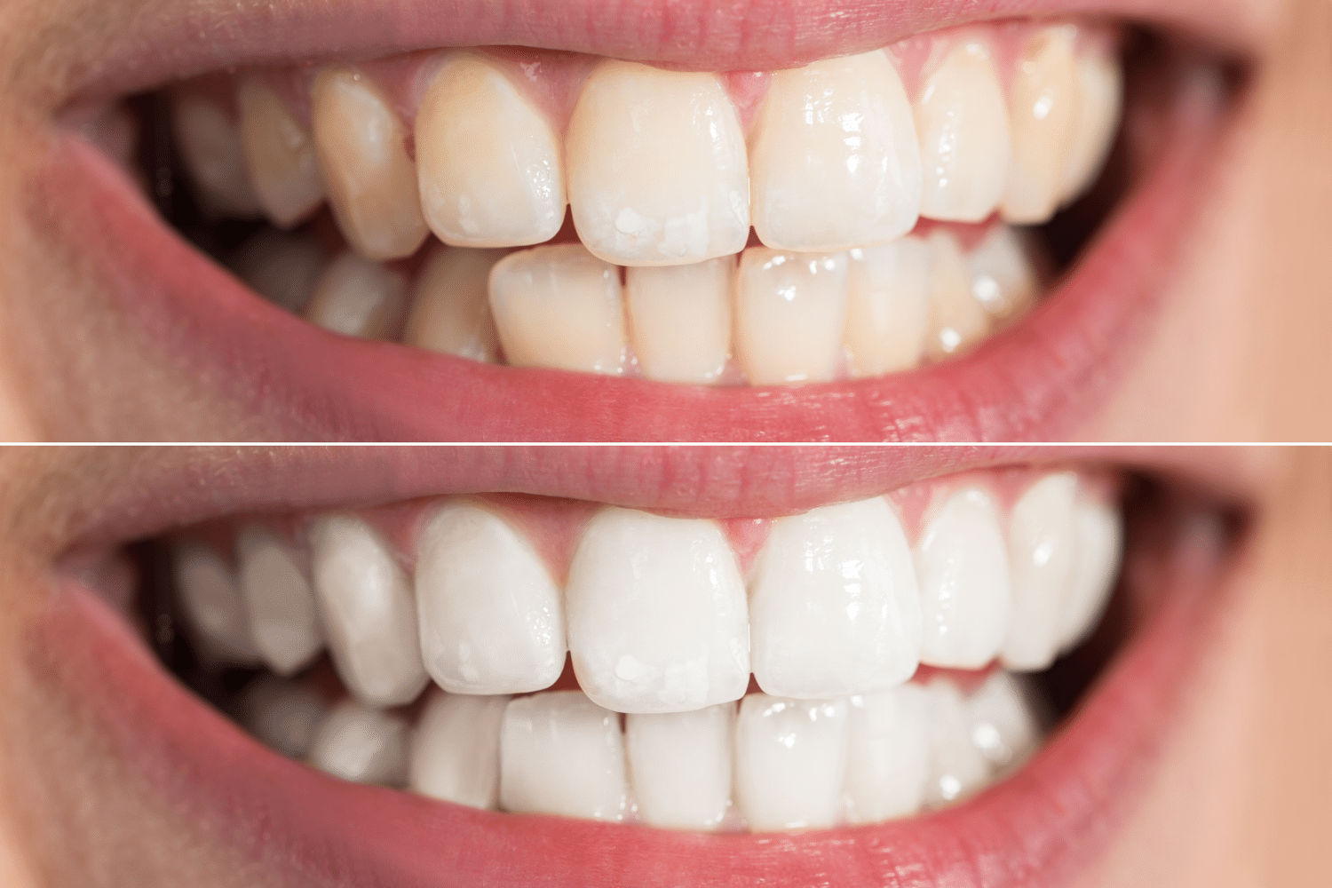 Teeth Whitening in Bengaluru by Dental Clinic